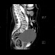 Cyst of ovary, gigantic: CT - Computed tomography
